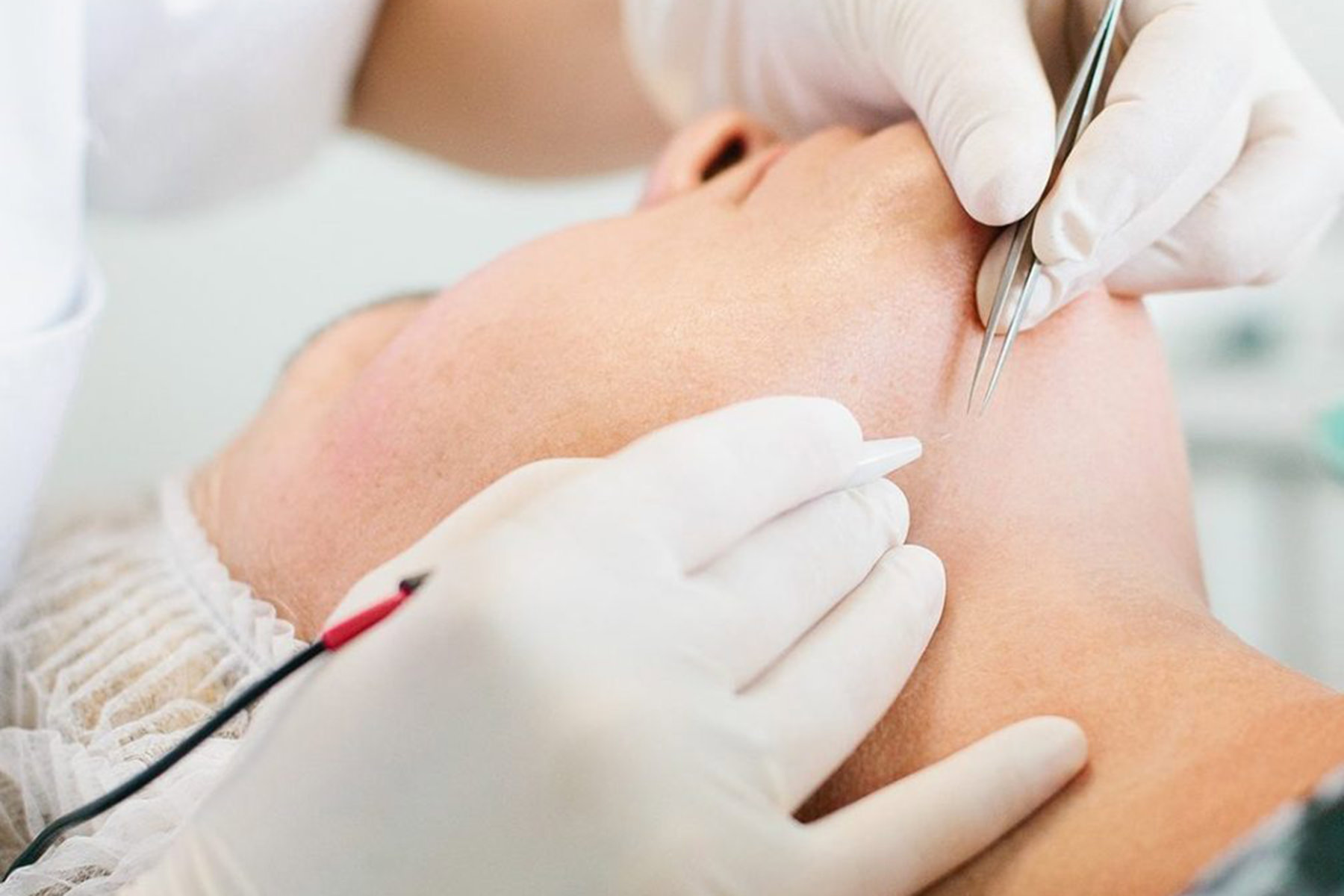 Huidpraktijk Nieuwkoop Definitieve ontharing Elektrische epilatie Huidpraktijk Nieuwkoop Definitieve ontharing Elektrische epilatie