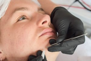 Huidpraktijk Nieuwkoop Elektrische epilatie