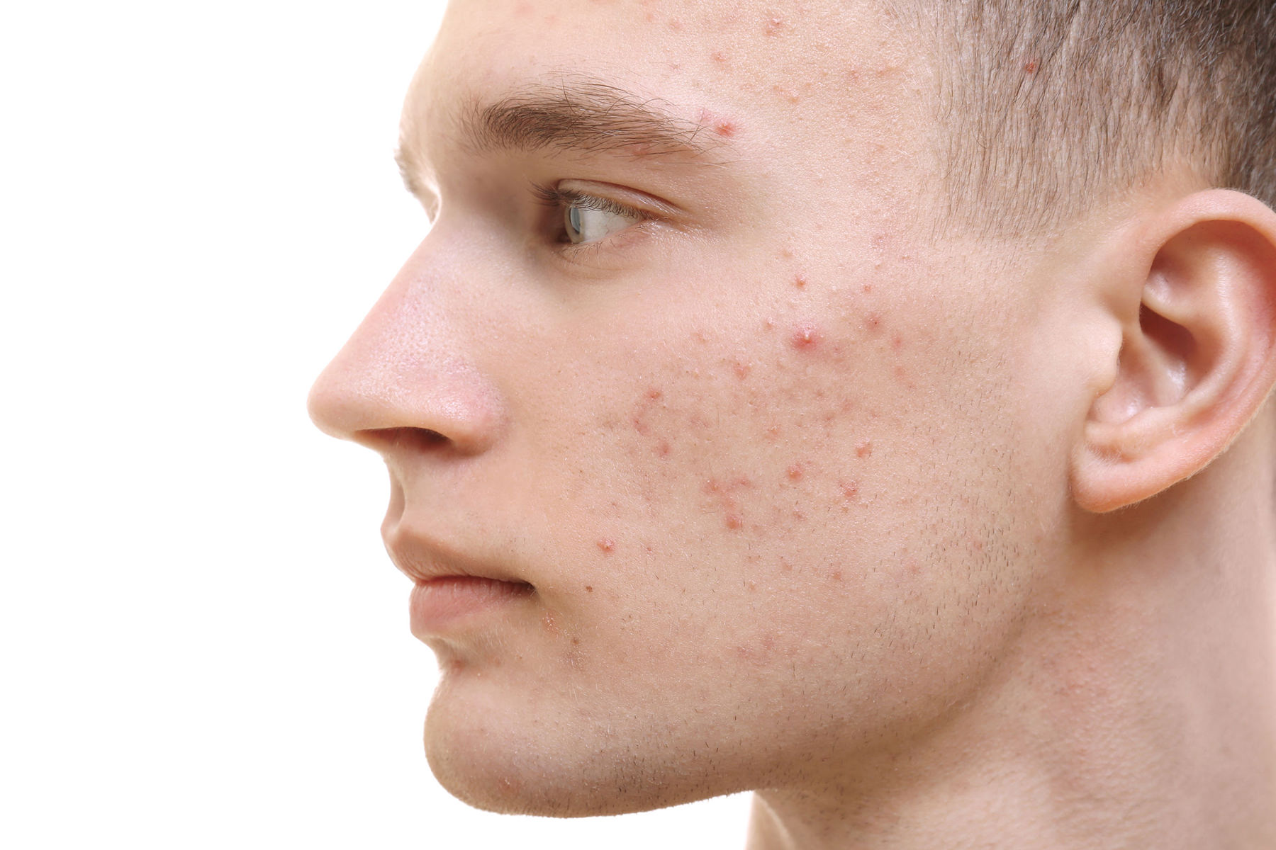 Huidpraktijk Nieuwkoop acne