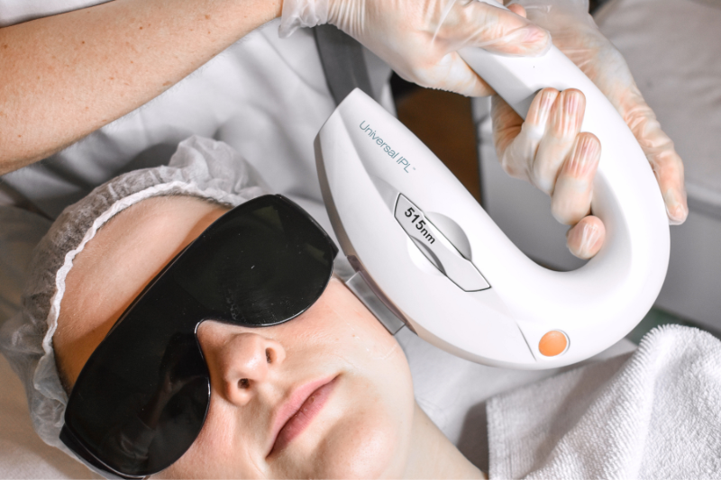 IPL Behandeling IPL Behandeling