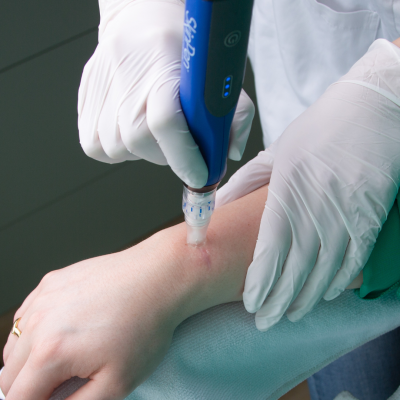 Microneedling skinpen behandeling Microneedling skinpen behandeling