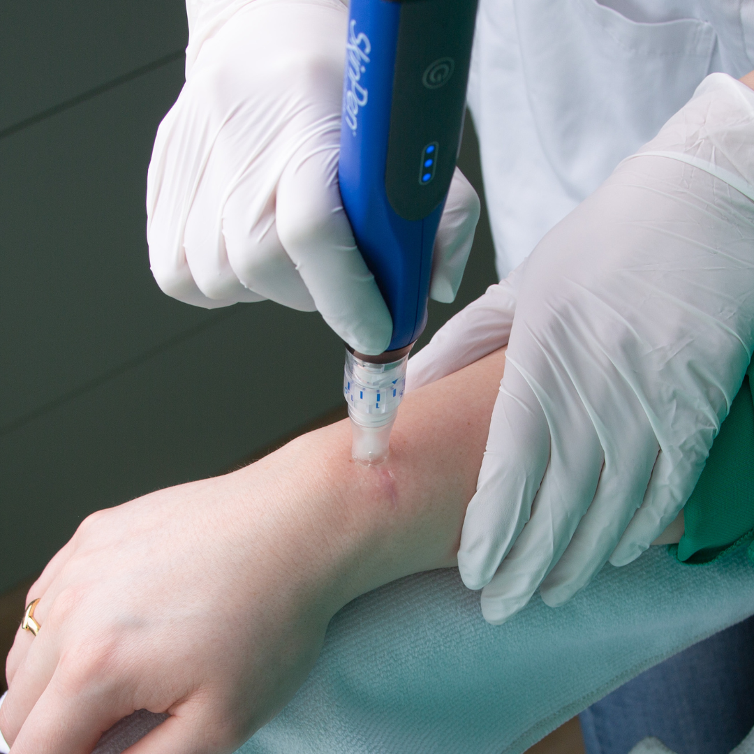 Microneedling skinpen behandeling Microneedling skinpen behandeling