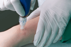 Microneedling skinpen behandeling
