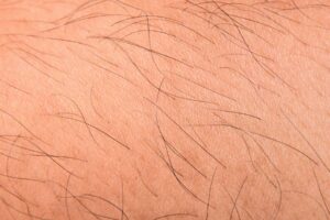 Ongewenste Haargroei