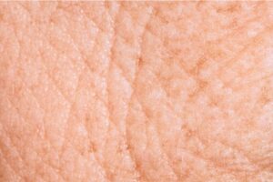 Rimpels en verslapping