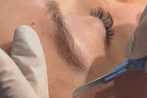 Dermaplaning behandeling