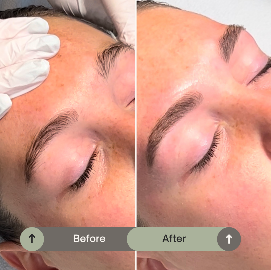 Before en after browmapping