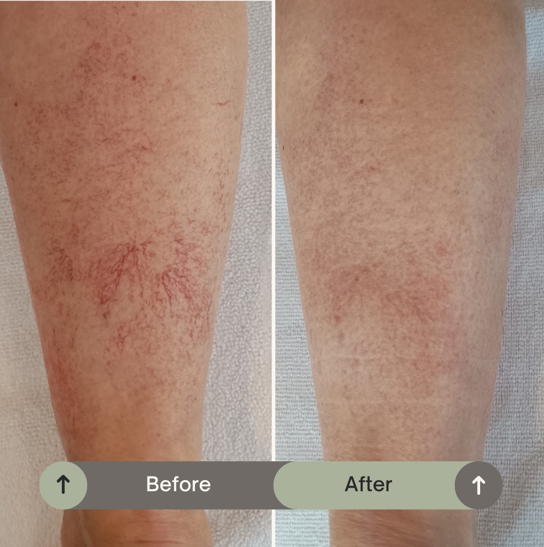 IPL_behandeling_benen (plaatsen bij huidaandoeningen roodheid) Resultaat roodheid benen IPL behandeling