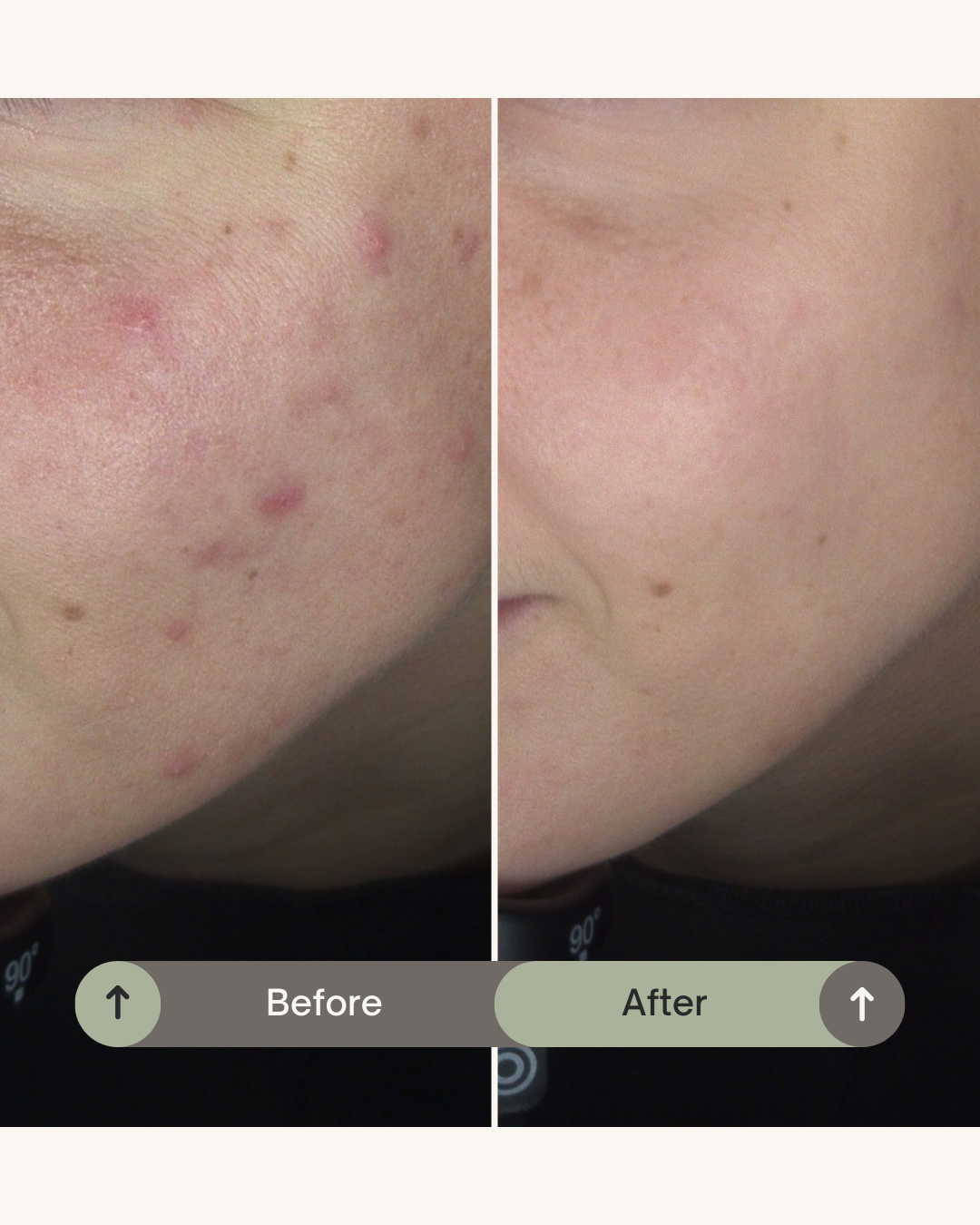 Bij acnetherapie behandeling Resultaat acnetherapie behandeling