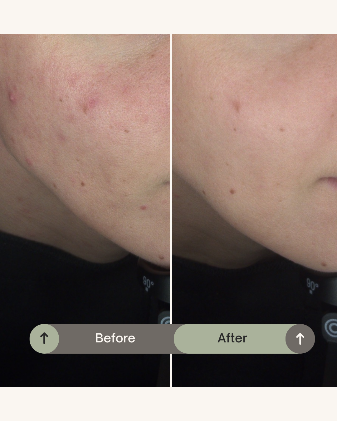 acne_tarda bij Acne behandeling Acne behandeling