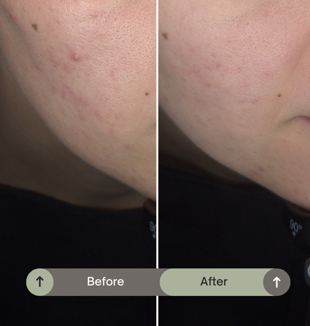 Resultaat skinpen behandeling