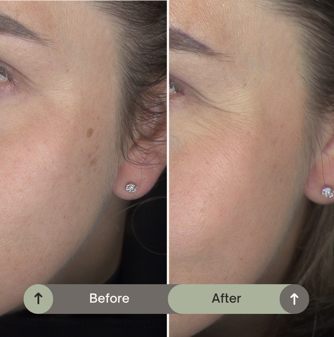 Resultaat ipl behandeling pigmentvlekken