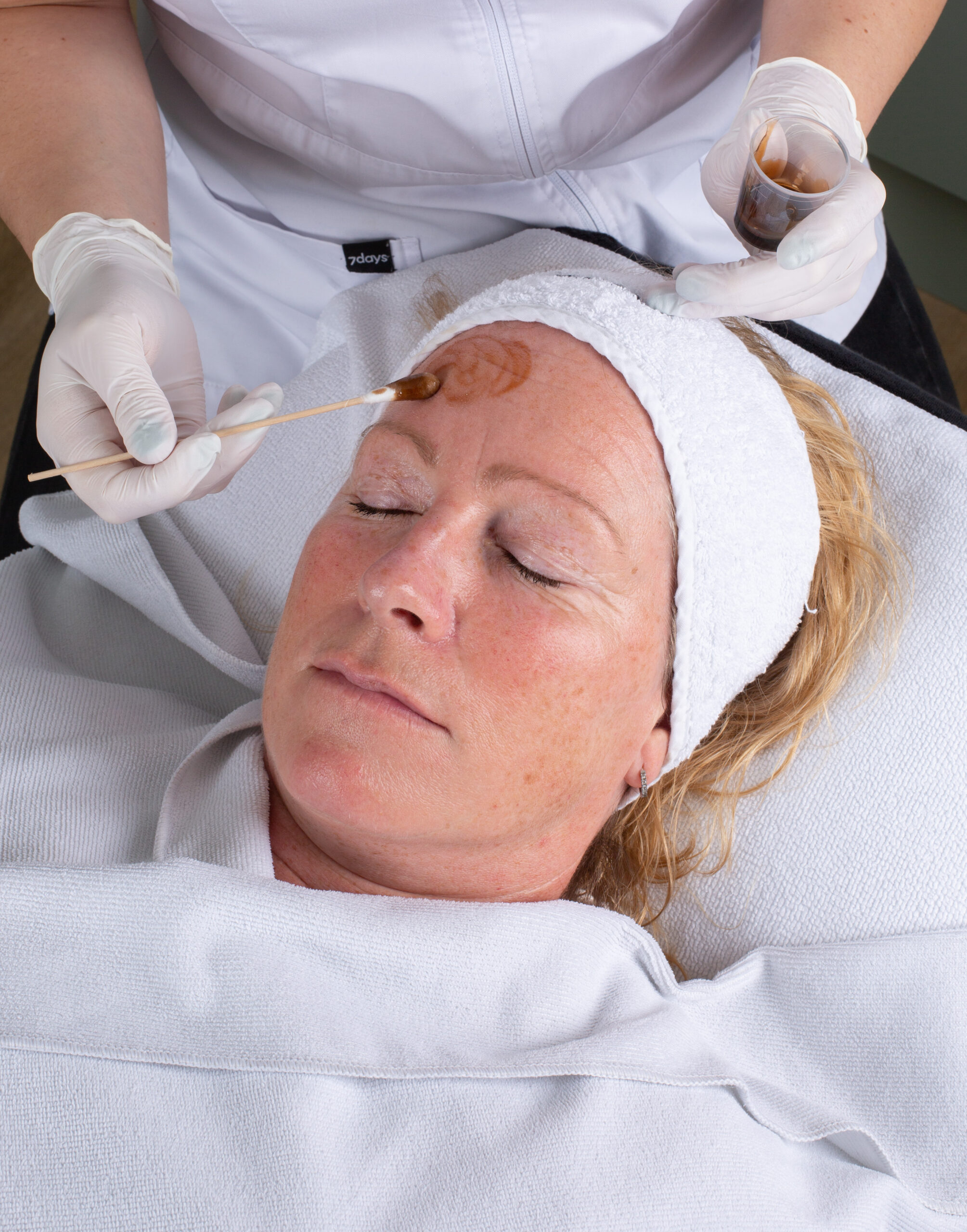 Behandeling, chemische peeling (als extra foto toevoegen mits het niet teveel wordt) Chemische peeling behandeling