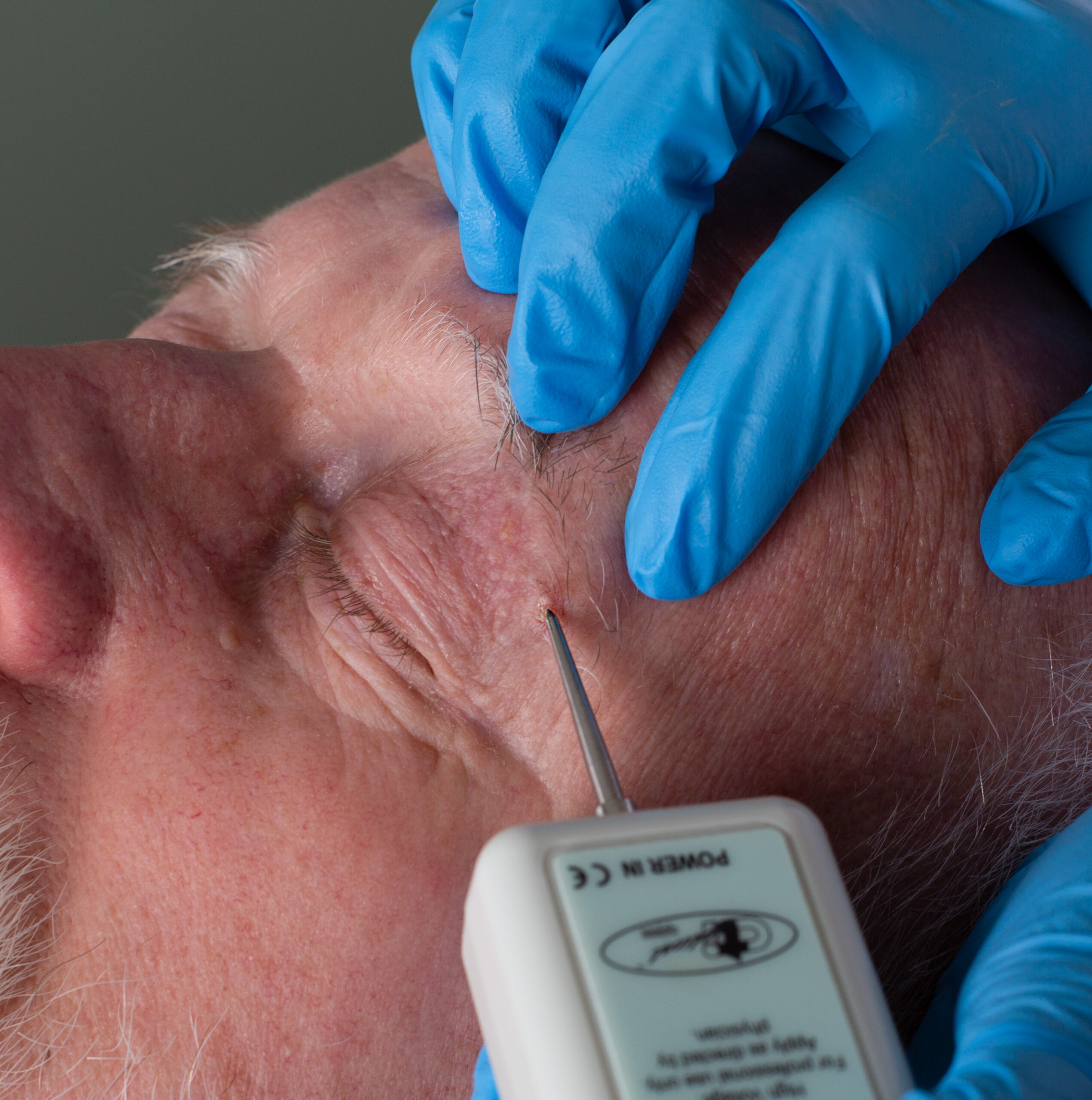 Foto behandeling Coagulatie goedaardige huidoneffenheden Coagulatie goedaardige huidoneffenheden behandeling