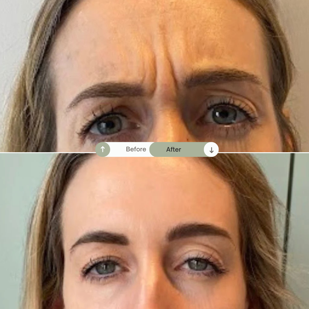 Resultaat botox behandeling