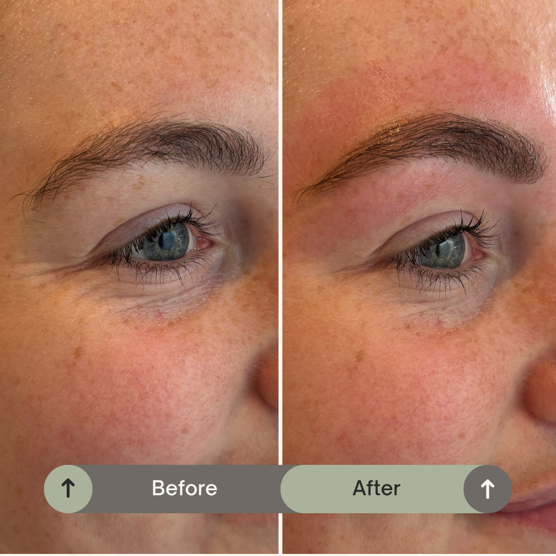 Before & after Browmapping, bij behandeling Browmapping.