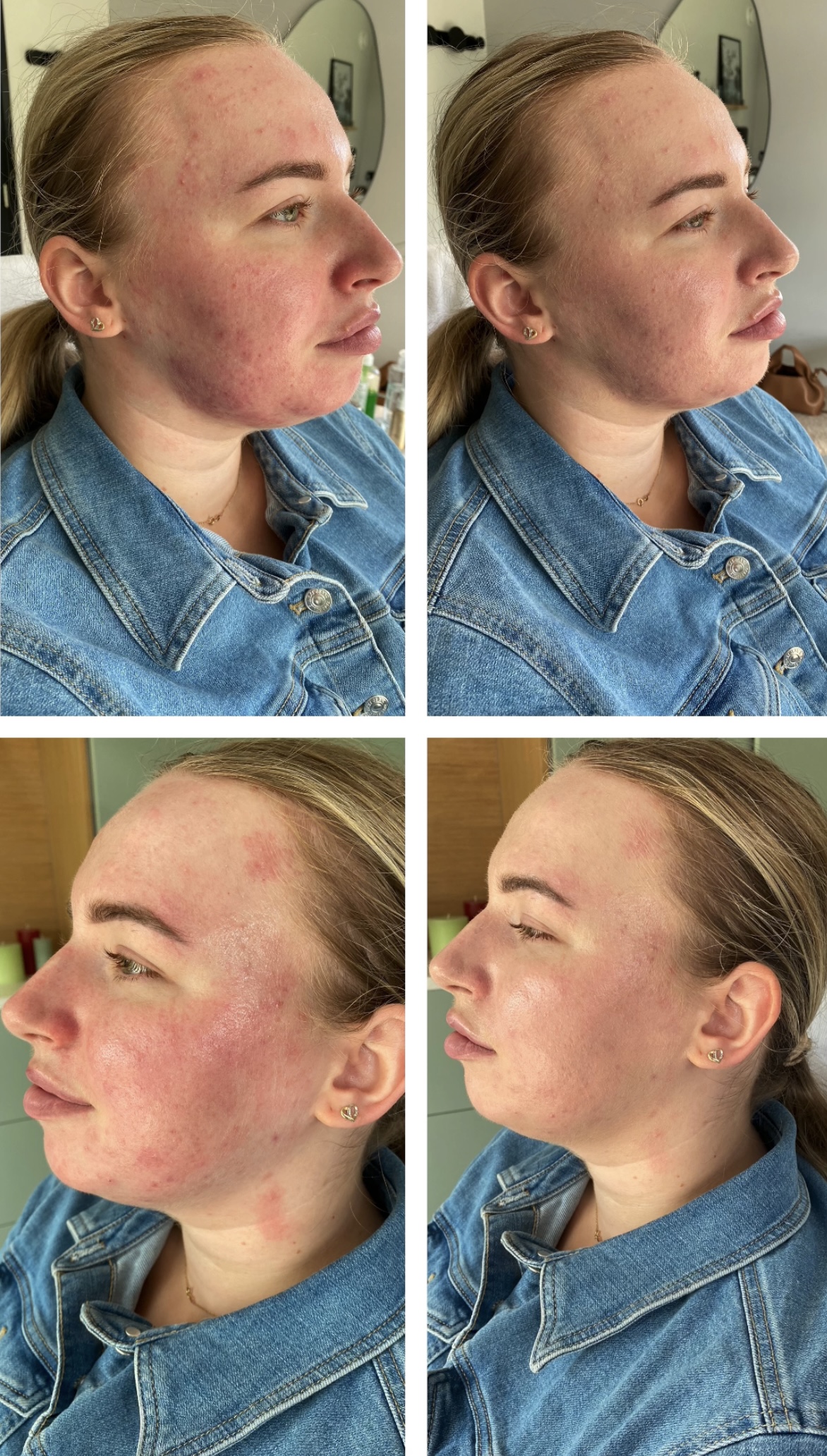 Before en after bij behandeling Camouflagetherapie.