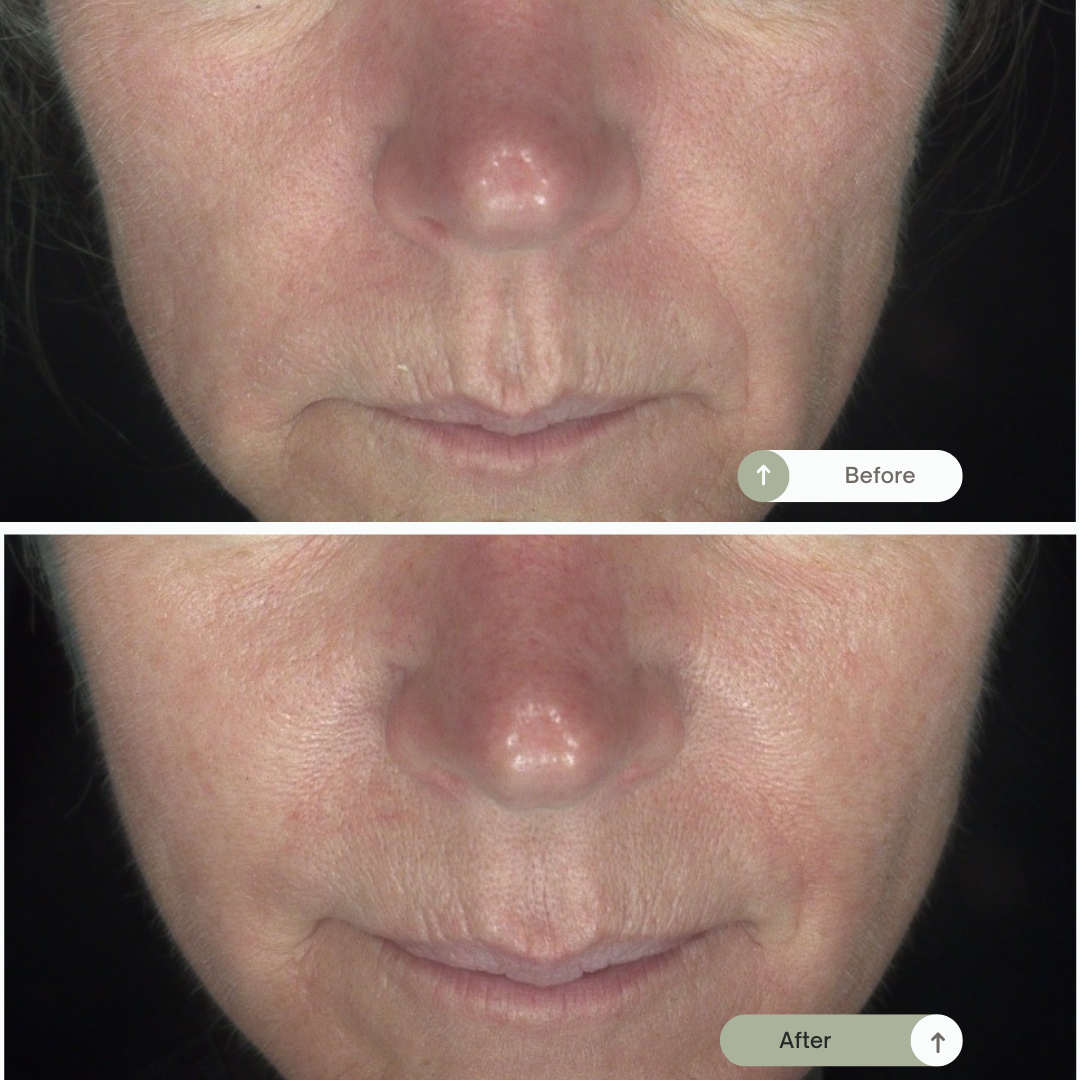 Before en After Mesotherapie. Behandeling mesotherapie Resultaat mesotherapie behandeling