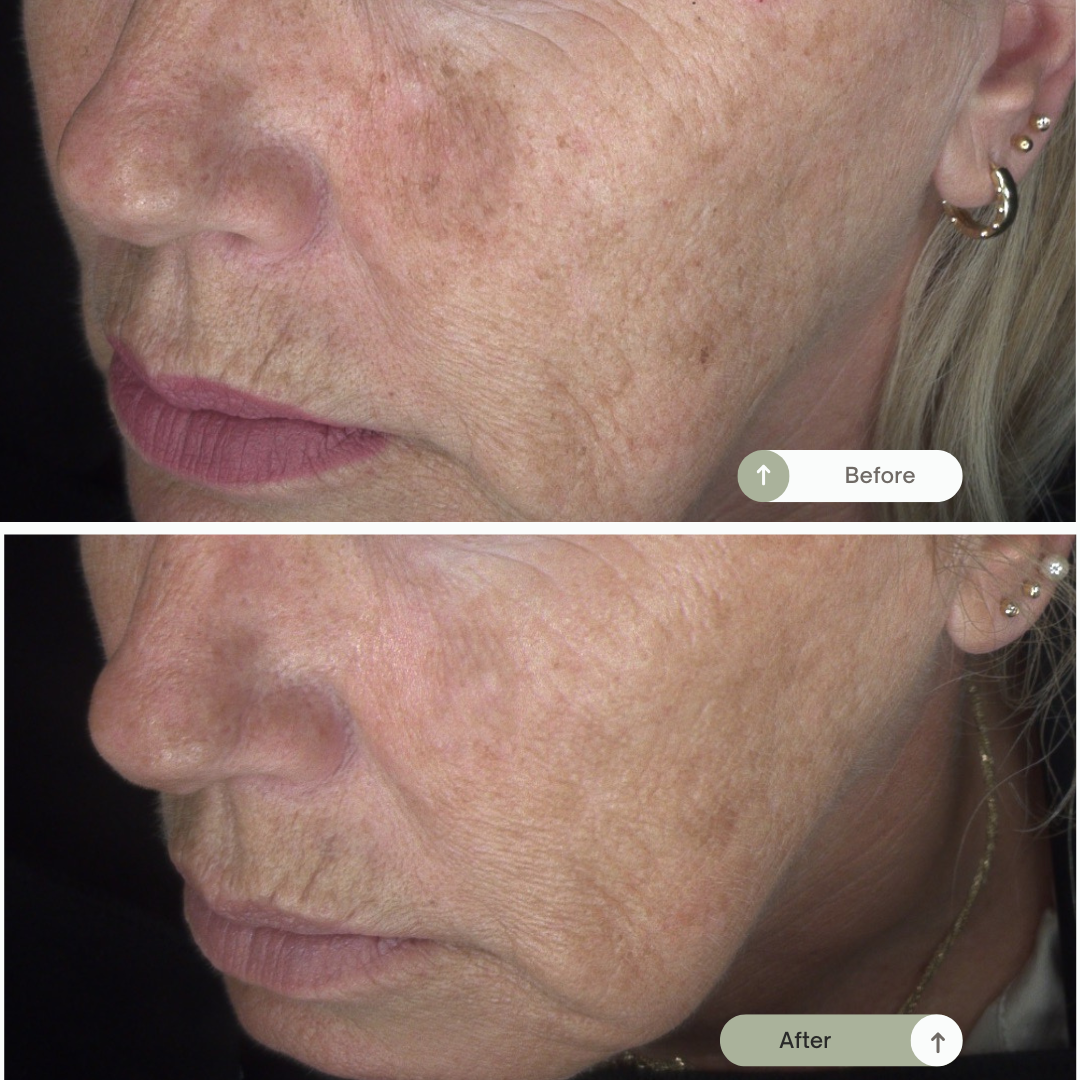 Before en after behandeling bij chemische peelings Resultaat chemische peeling