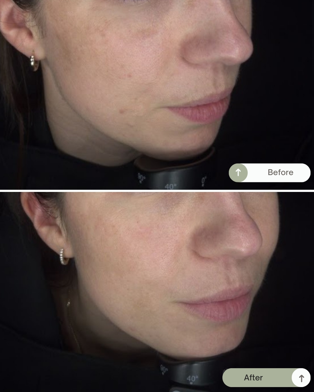 Melanopro voor en na foto